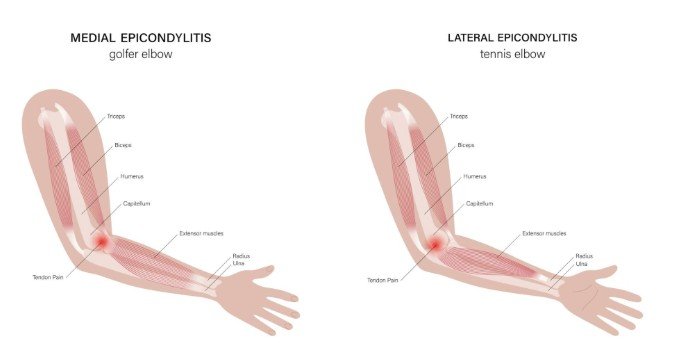 epicondilite gomito padel infiammazione tendini braccio